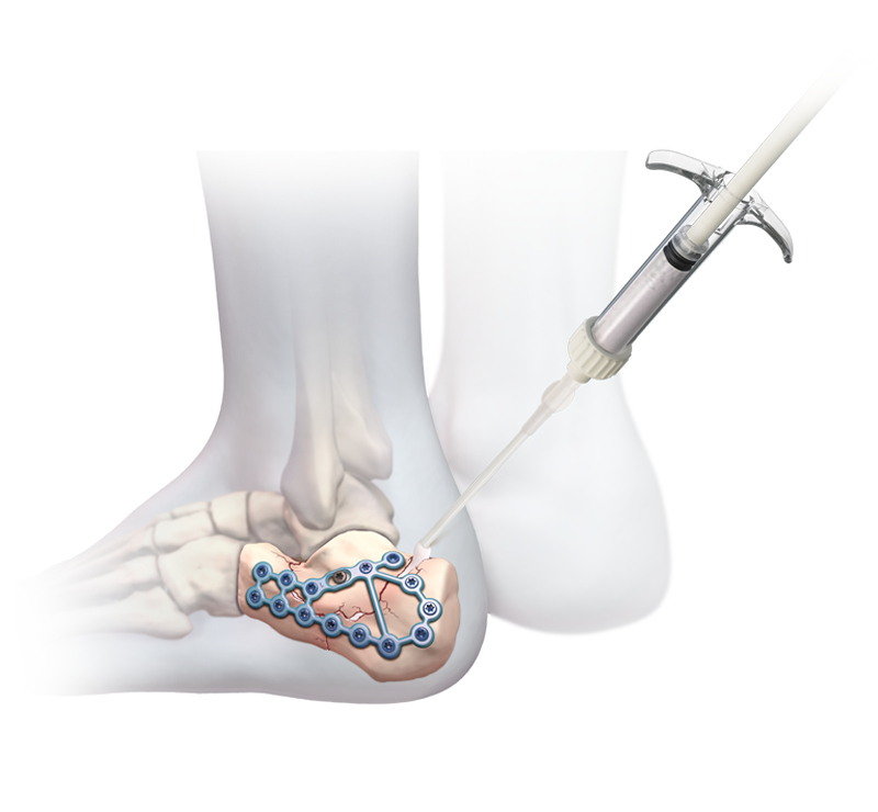Arthrex - BoneSync Fast-Setting Drillable Calcium Phosphate Arthrex - BoneSync Fast-Setting Drillable Calcium Phosphate